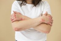 Penyakit autoimun dapat menyerang siapa saja, tetapi perempuan memiliki risiko yang jauh lebih tinggi dibandingkan laki-laki.
