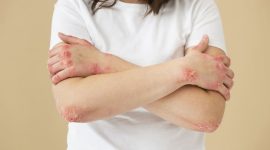 Penyakit autoimun dapat menyerang siapa saja, tetapi perempuan memiliki risiko yang jauh lebih tinggi dibandingkan laki-laki.