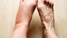 Kaki bengkak setelah berdiri lama atau melakukan aktivitas berat bisa terjadi pada banyak orang.