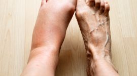 Kaki bengkak setelah berdiri lama atau melakukan aktivitas berat bisa terjadi pada banyak orang.