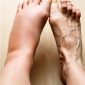Kaki bengkak setelah berdiri lama atau melakukan aktivitas berat bisa terjadi pada banyak orang.