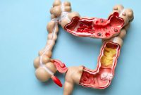 Radang usus buntu atau apendisitis kembali menjadi perhatian publik setelah selebgram Fahira Almira mengungkapkan dirinya didiagnosis mengalami penyakit tersebut.