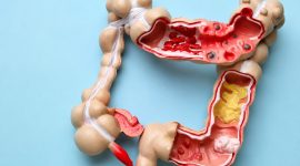 Radang usus buntu atau apendisitis kembali menjadi perhatian publik setelah selebgram Fahira Almira mengungkapkan dirinya didiagnosis mengalami penyakit tersebut.